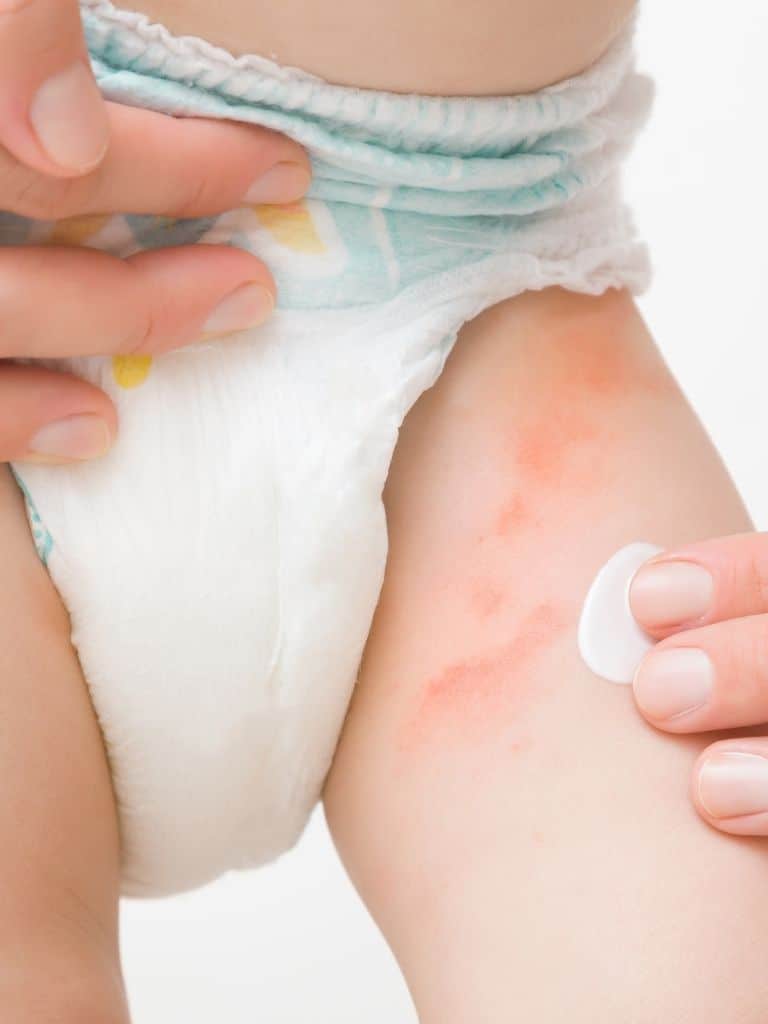 Disposable-Diapers-May-Lead-To-Skin-Rashes